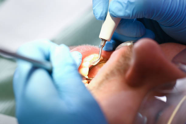 Best Emergency Dental Care for Broken or Chipped Teeth in Bellville, OH